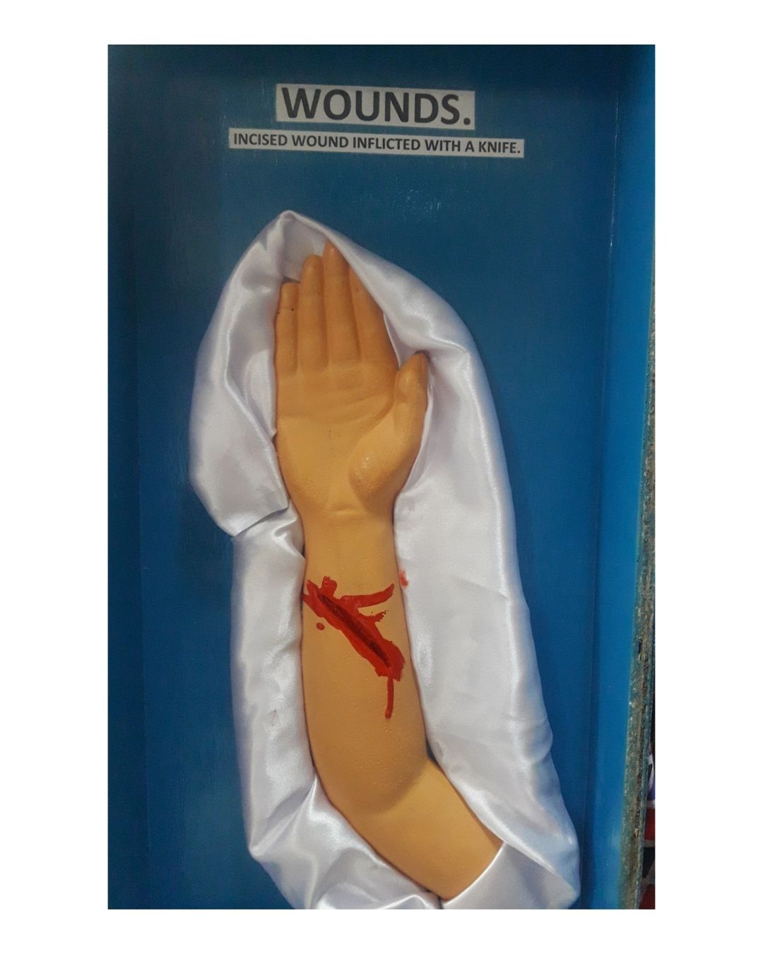 Incised Wound Inflicted with a Knife (Forearm)