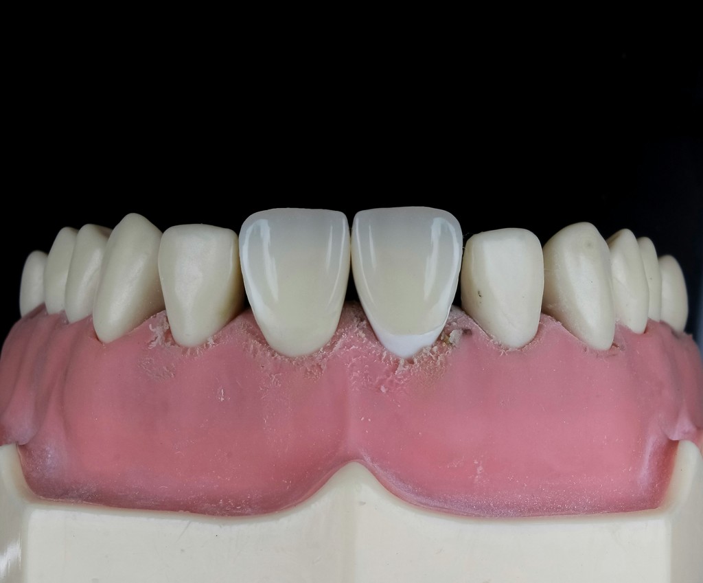 Teeth Whitening