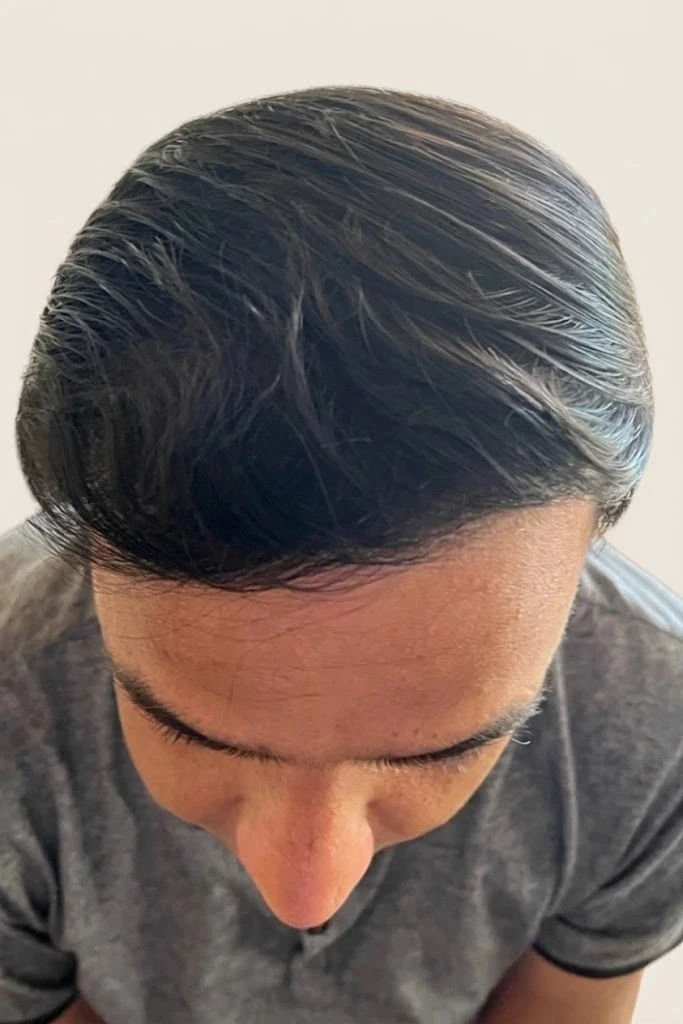 Dichtes Ergebnis nach der Saphir-FUE Haartransplantation in der Partnerklinik Türkei