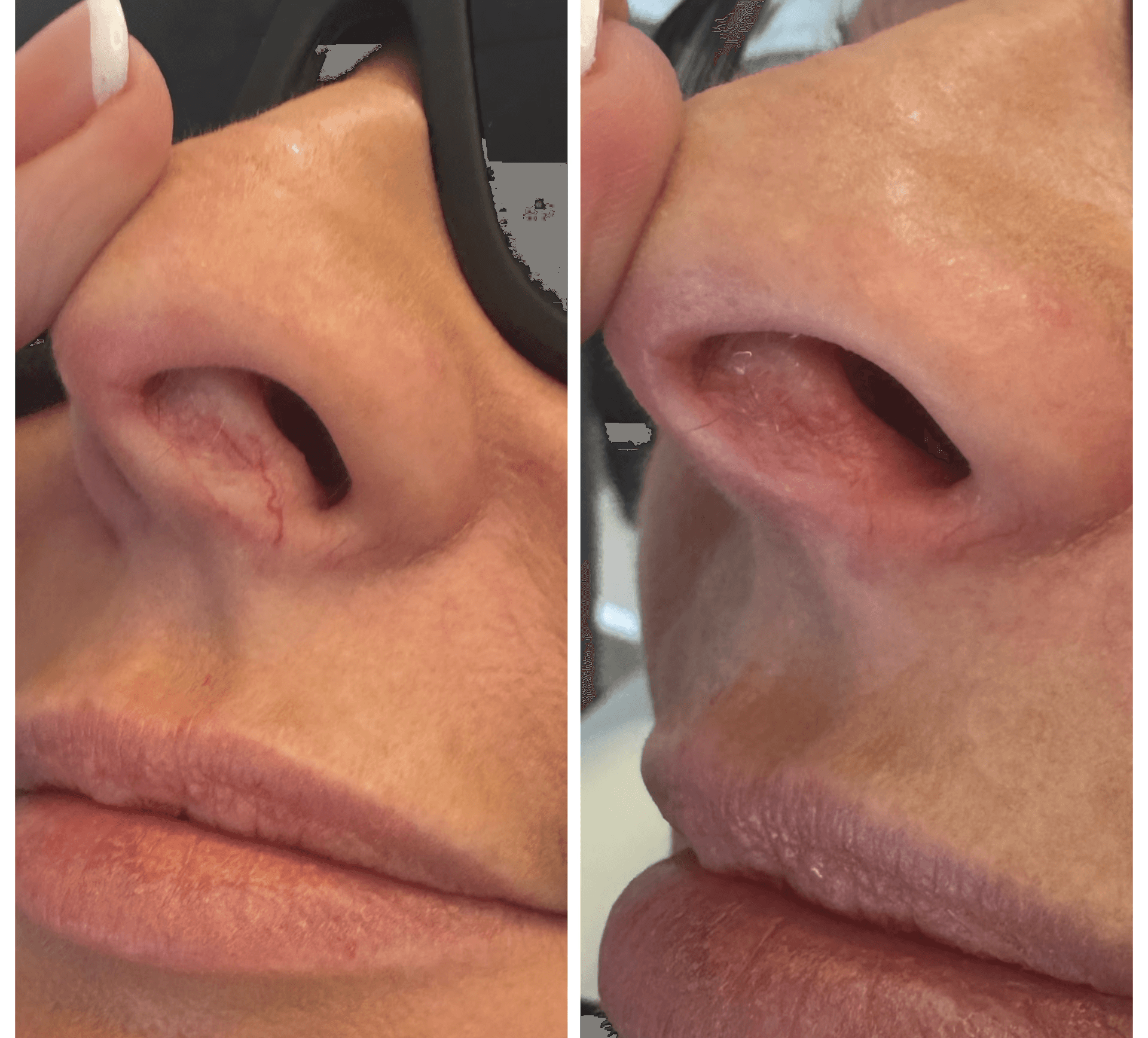 Before and after of nose with prominent blood vessels.