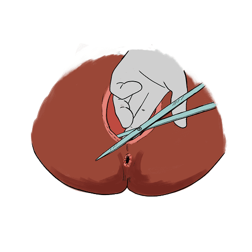 An illustration of a gloved hand supporting a perineum and using scissors to make a cut at a 45 degree angle on the right side of the perineum called an episiotomy.