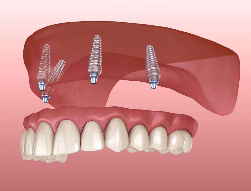 Maximum Support Same Day All-On-X Implant Supported Dentures SN Family Dental