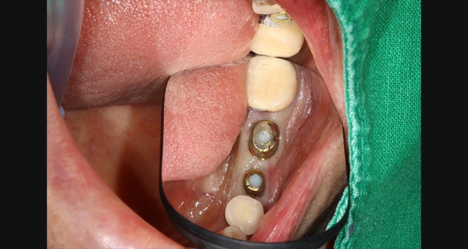 커스텀 장착