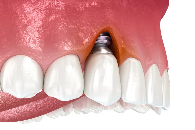 peri-implantits treatment