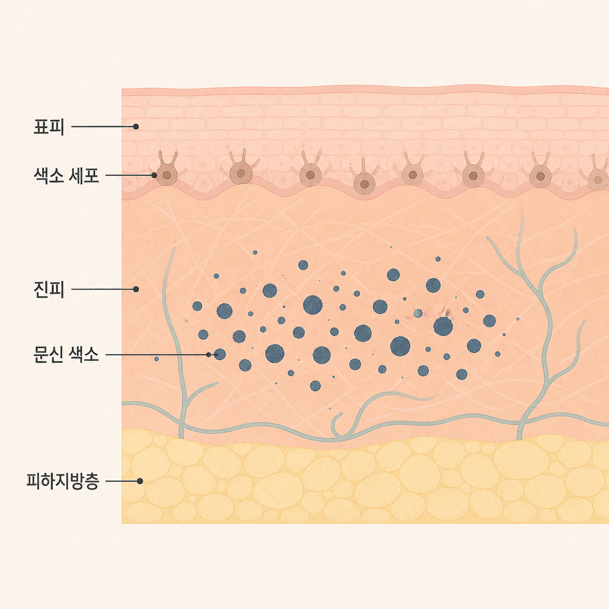 표피의 색소 세포와 진피에 자리 잡은 문신 색소