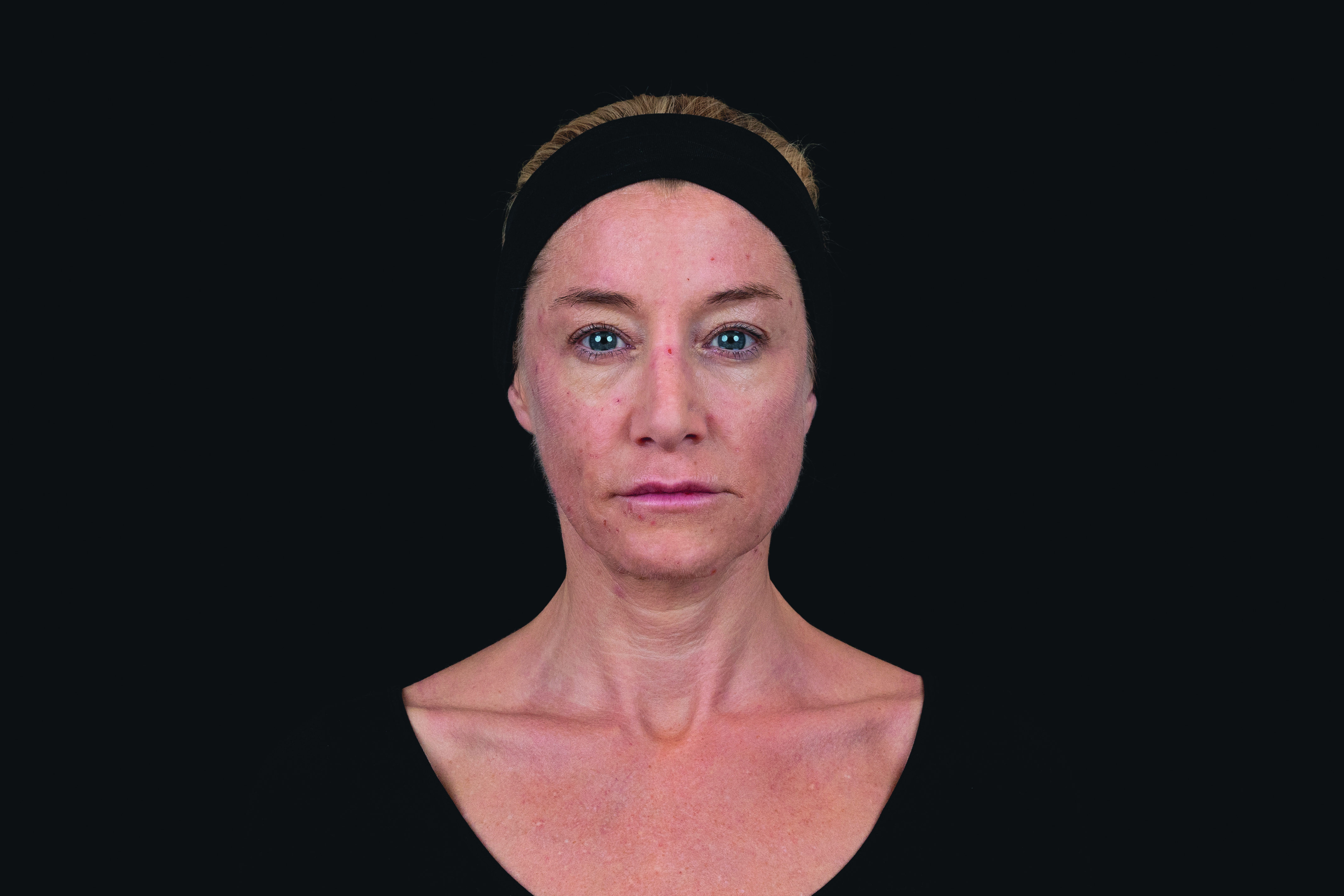 After portrait of the same female model following Croma Saypha Volume Plus Lidocaine dermal filler