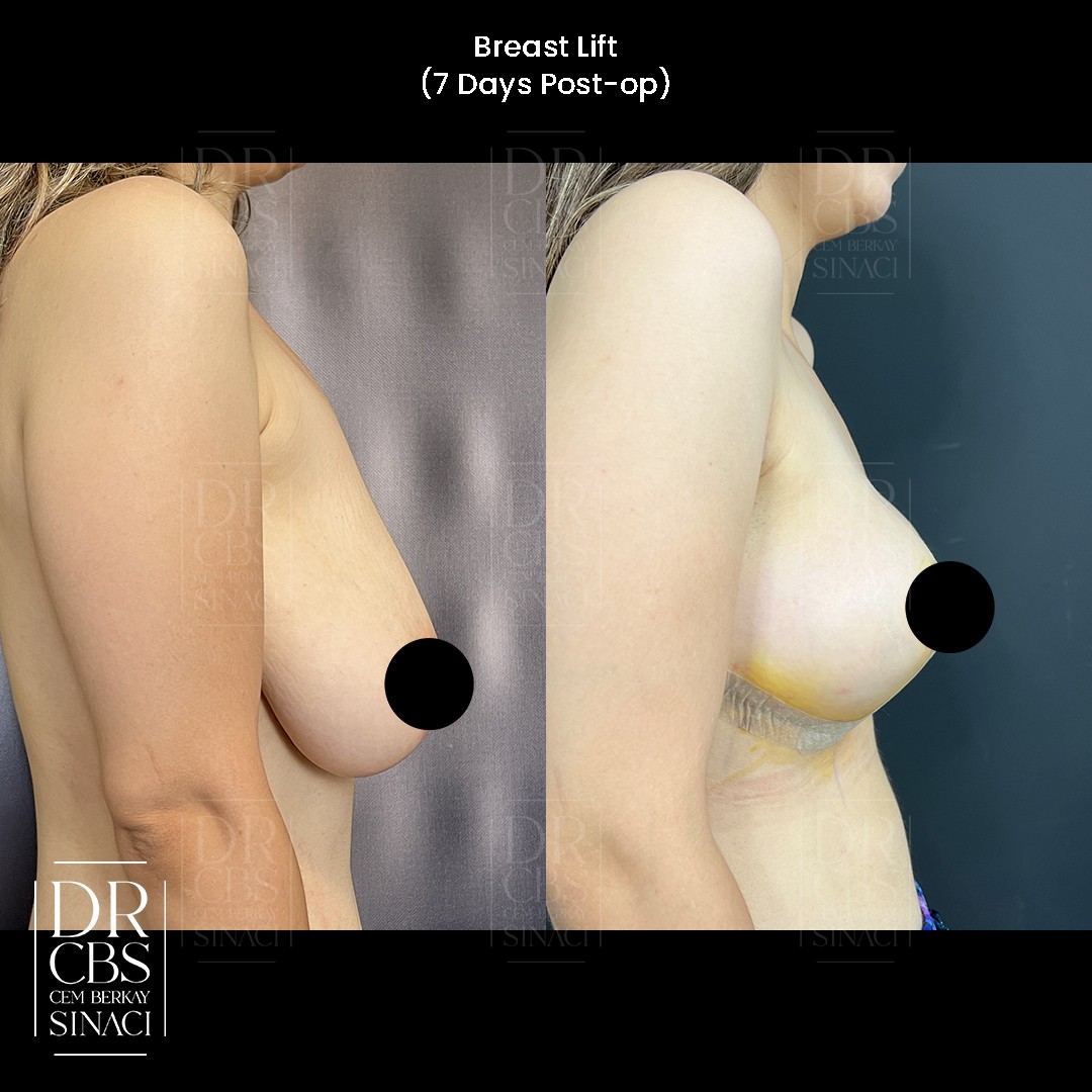 breast lift before after 7 days side view