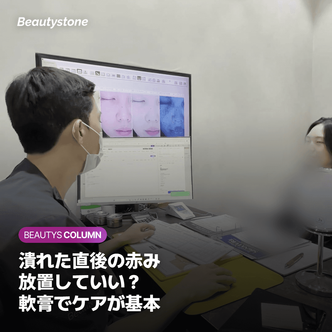 ニキビが潰れた直後の赤みは再生軟膏でケアする