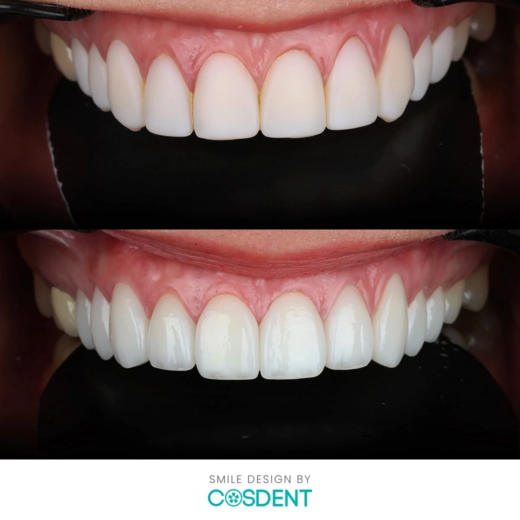 รีวิวออกแบบรอยยิ้ม ที่ cosdent smile design