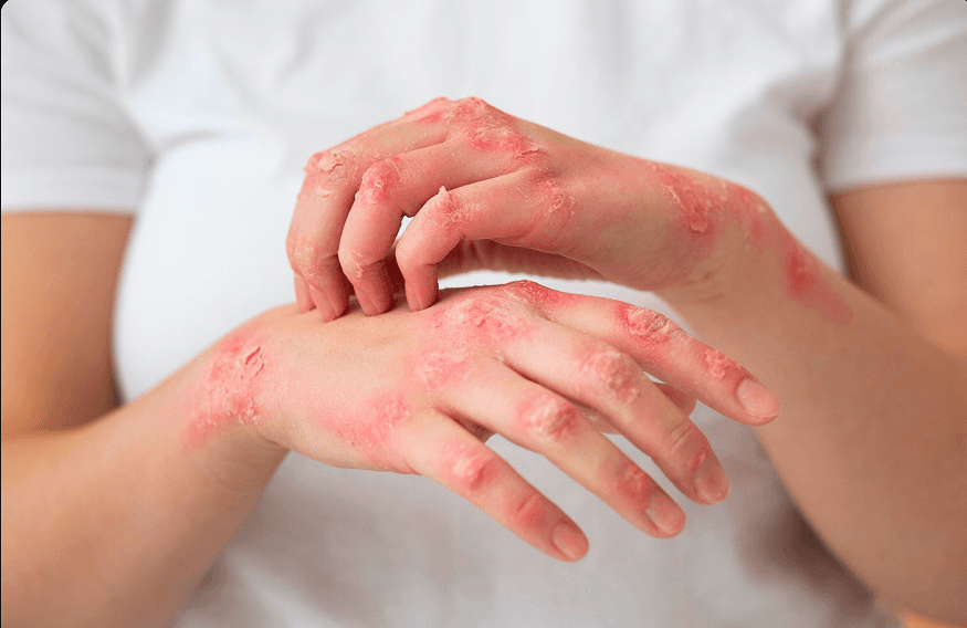 Fungal Infection Treatment Kondpaur Hyderabad, Yuti Clinics