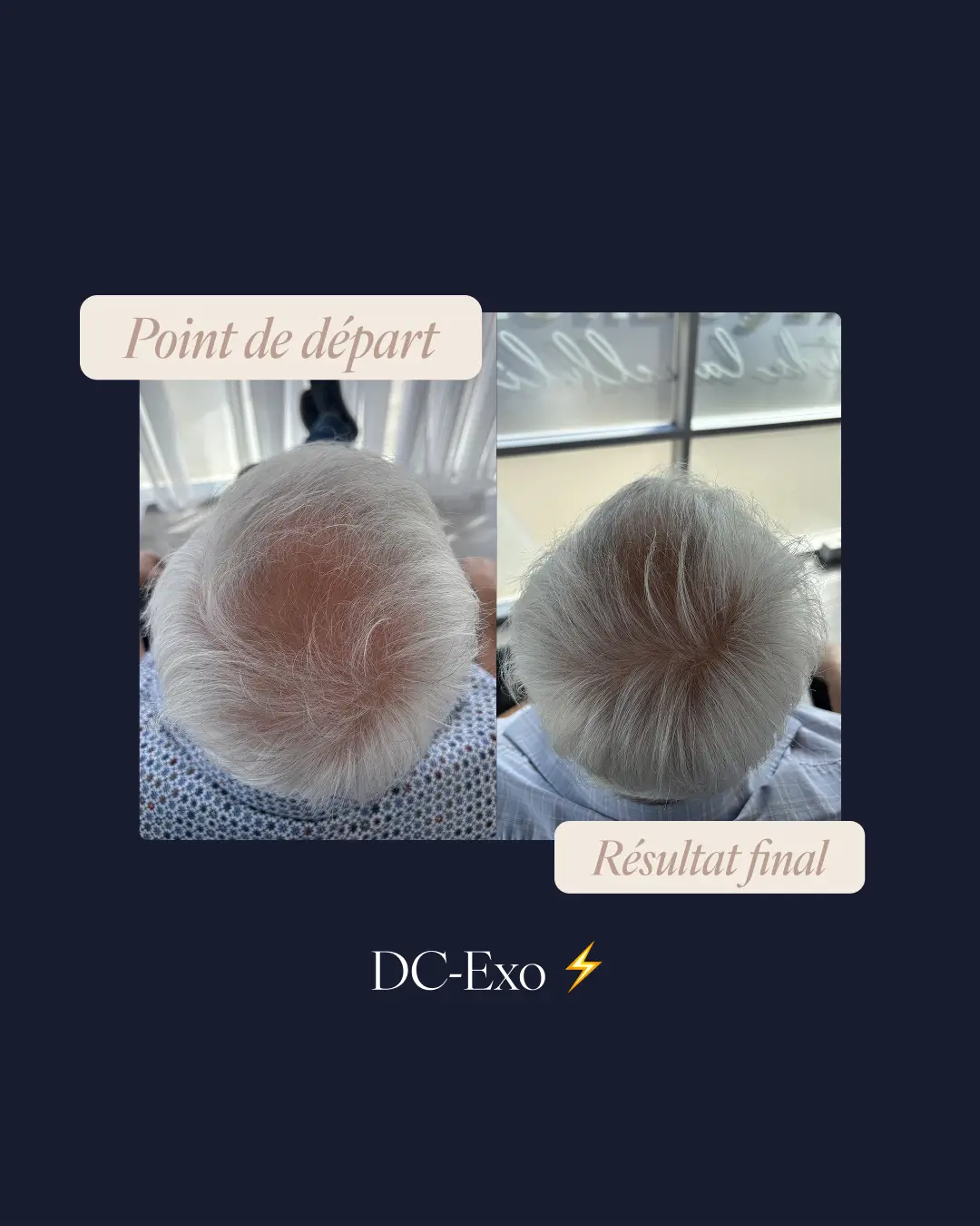 une photo du vortex du front d'un avant-après prp exosome perte de cheveux a laval dans une clinique medico-esthetique