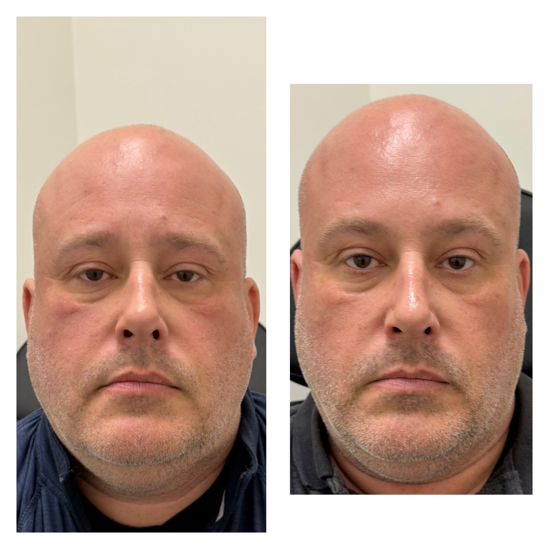 man forehead botox hagerstown md