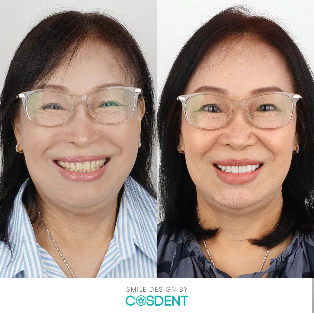 คุณ บุญกอง befor and after ผลงานออกแบบรอยยิ้มวีเนียร์ cosdent smile design