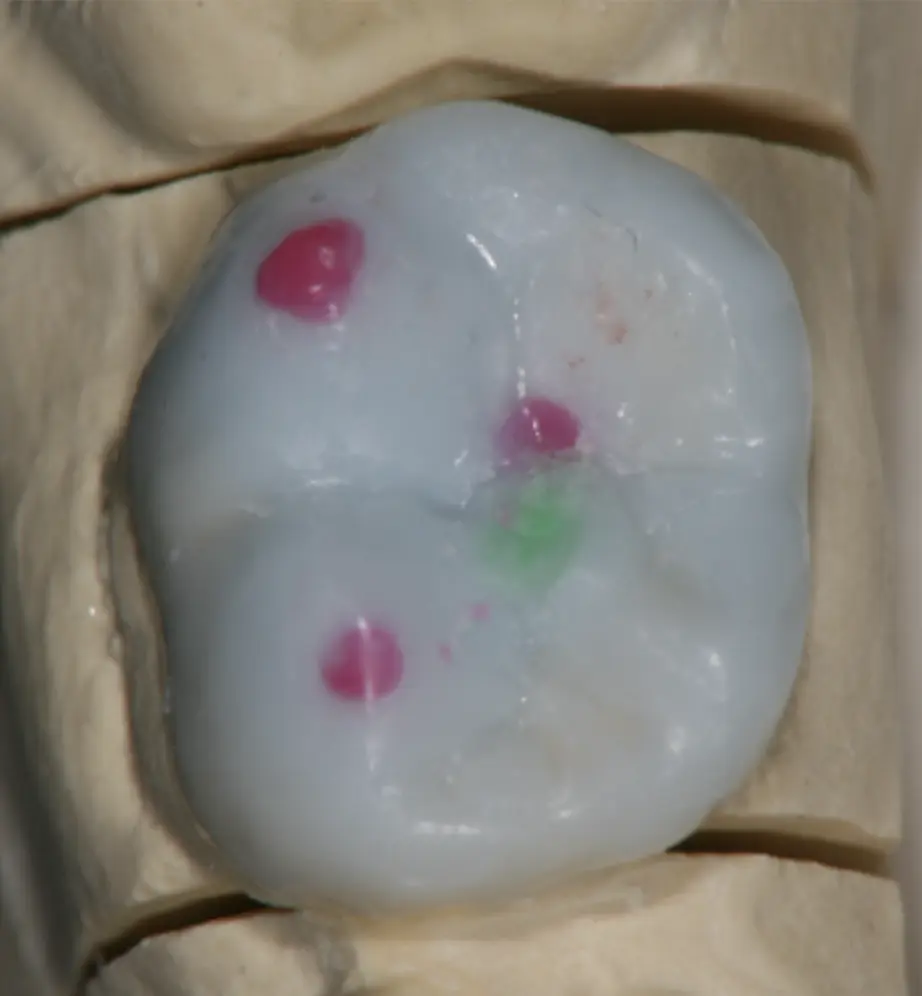 Wax-up-Entwurf der zukünftigen Onlays mit einem speziellen Mechanismus, der den Unterkiefer in eine  grundlegend bessere physiologische Position bringt. Dieser Ansatz entlastet die Kiefergelenke (TMJs)  und fördert ein gesundes Wachstum der Kiefer sowie der Gesichts- und Schädelknochen.