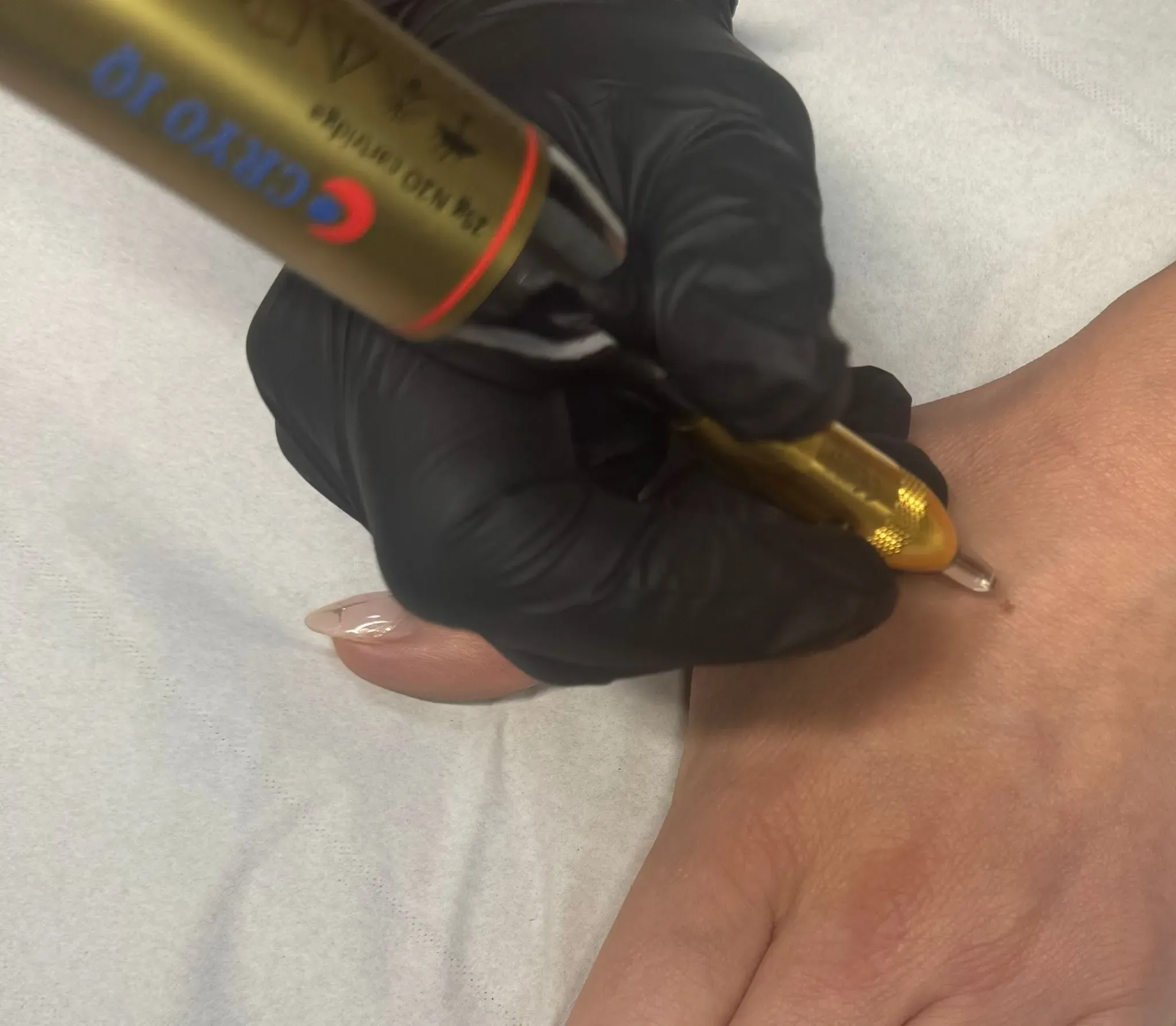 Student performing crypopen on hand