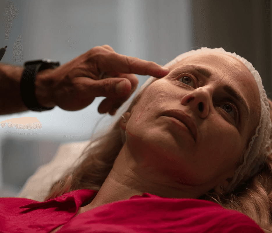 SkinPen® e Microneedling: la nuova frontiera per migliorare la qualità della pelle