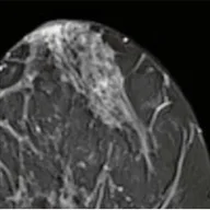 Image of a Mamma MRI scan