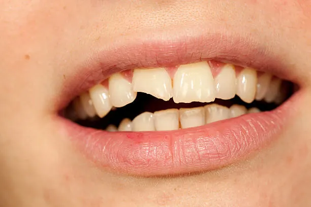 Intraoral Cameras