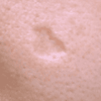 박스형흉터 아래로 꺼져잇는 전체적인 세포가 녹은 흉터 수두자국도 비슷함 | 뷰티스톤의원 흉터전문