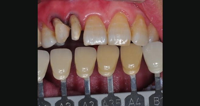 변색이 심한 치아 쉐이드 테이킹