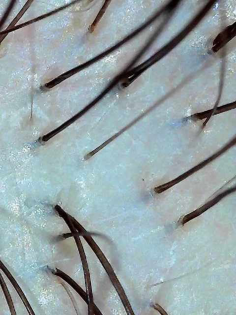 Microscopic close-up of the same scalp after purifying treatment
