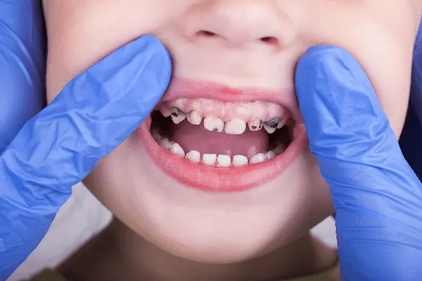 Intraoral Cameras