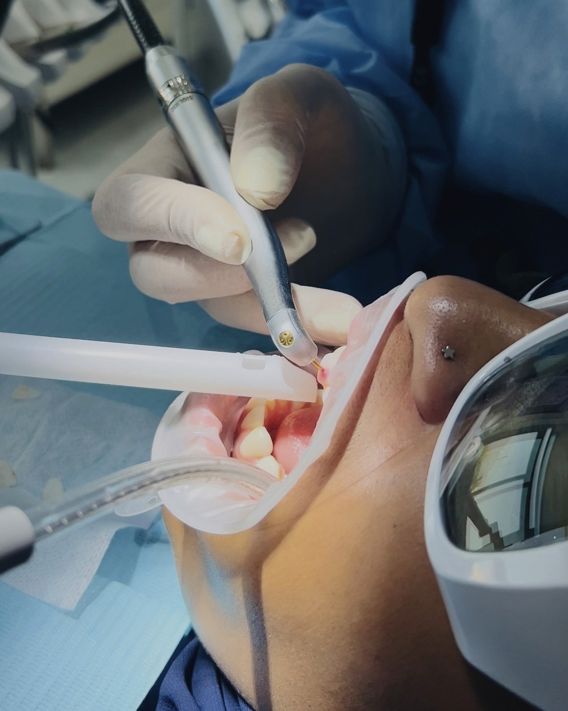 Gum pigmentation session with a cosmetic dentist performing the treatment using laser method, ensuring precise and safe results.