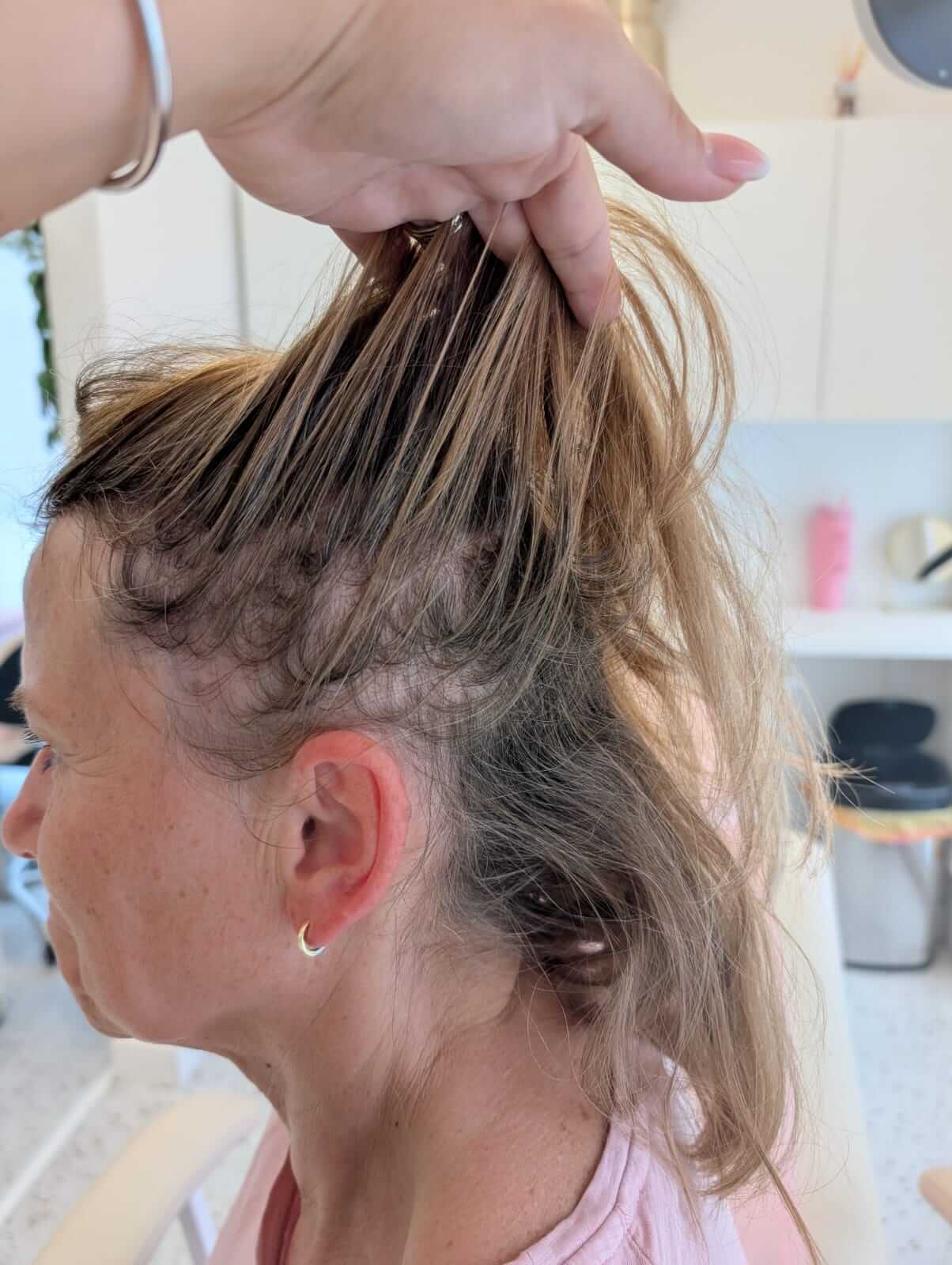 Fotografia vlasovej mezoterapie v polovici cyklu 6 ošetrení.