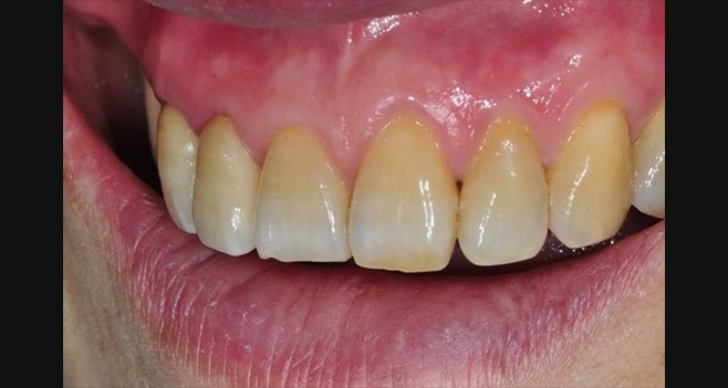 Emax 세팅후 사진