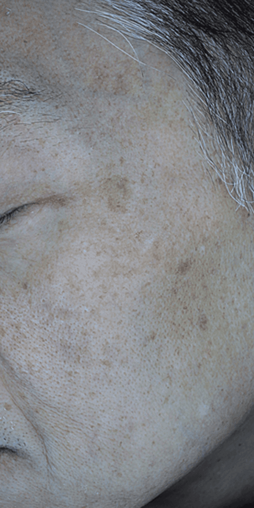 Pigmentation - After