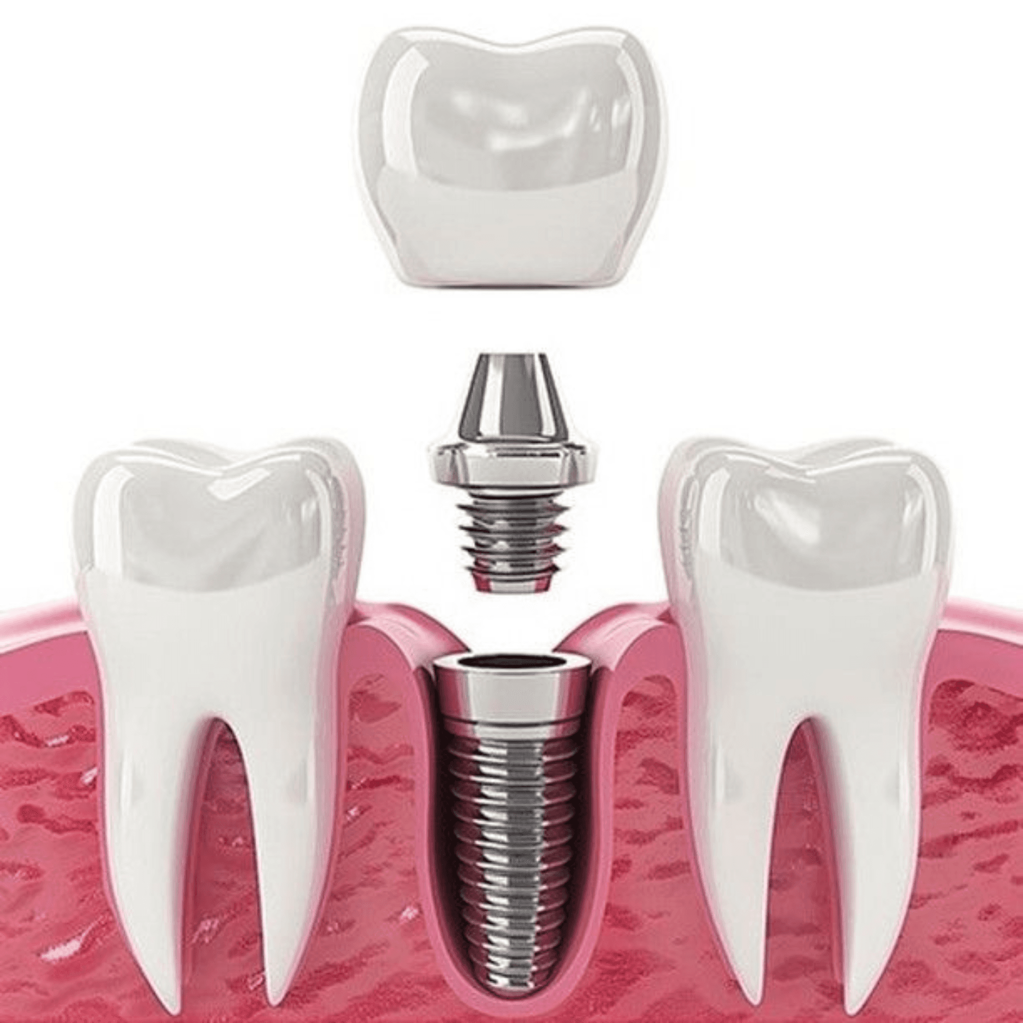Titāna zobu implants