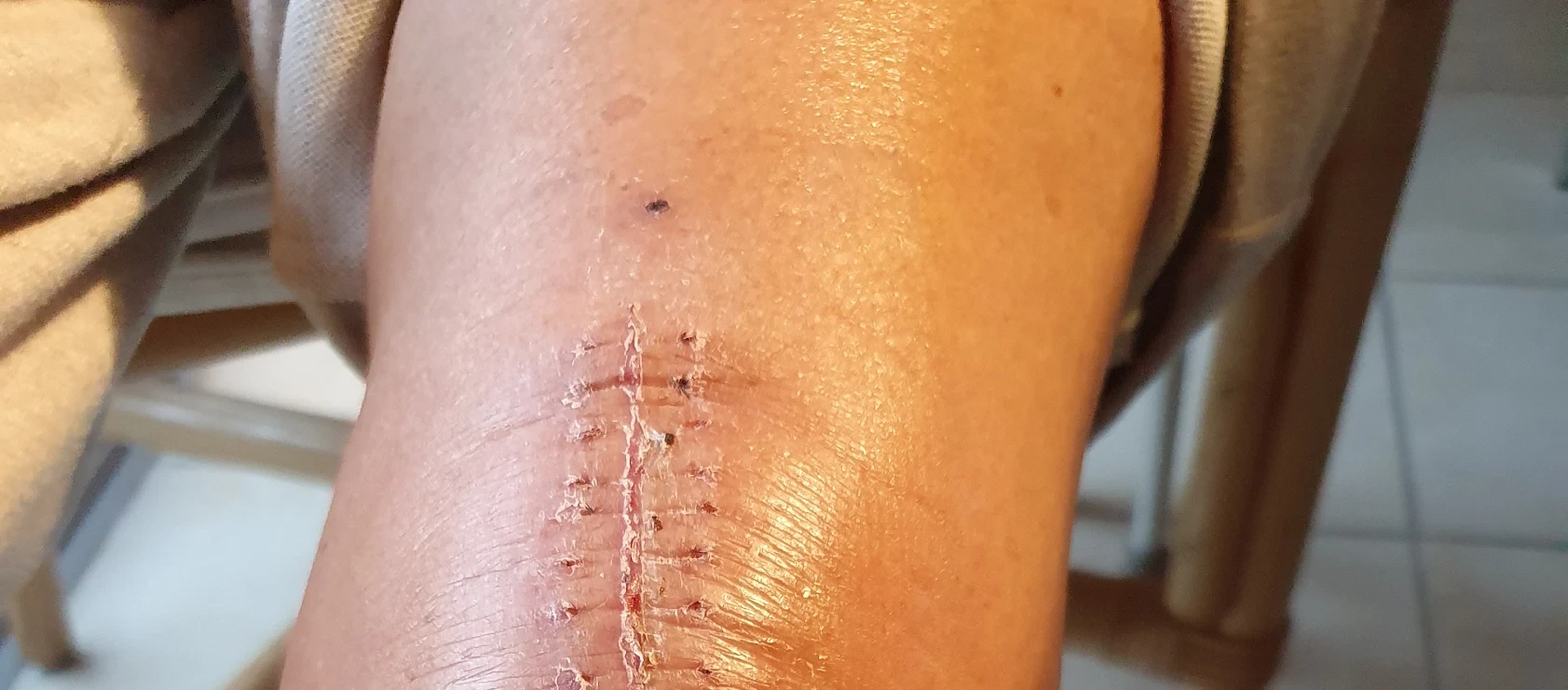 WINTERMED Operation am Knie, Knie Kinetec