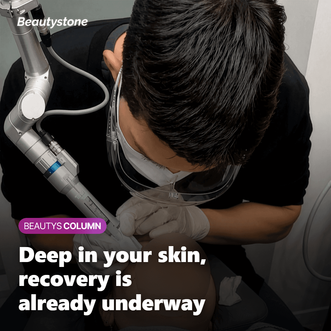 Illustration of Ultherapy PRIME ultrasound reaching the deep SMAS layer