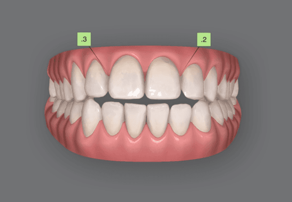 open bite - one of the teeth misalignment conditions treated with invisalign by Bella Medical Centre's orthodontists