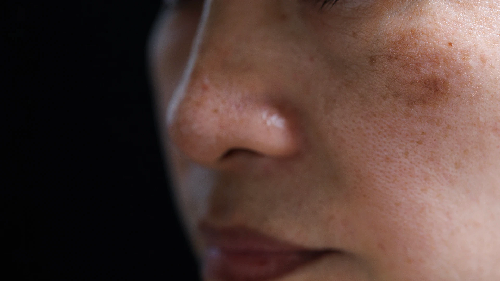 Melasma on woman’s face.