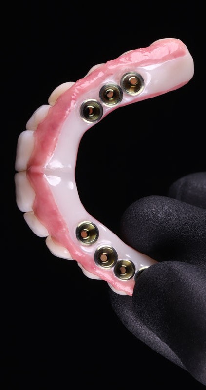 full-mouth dental implants