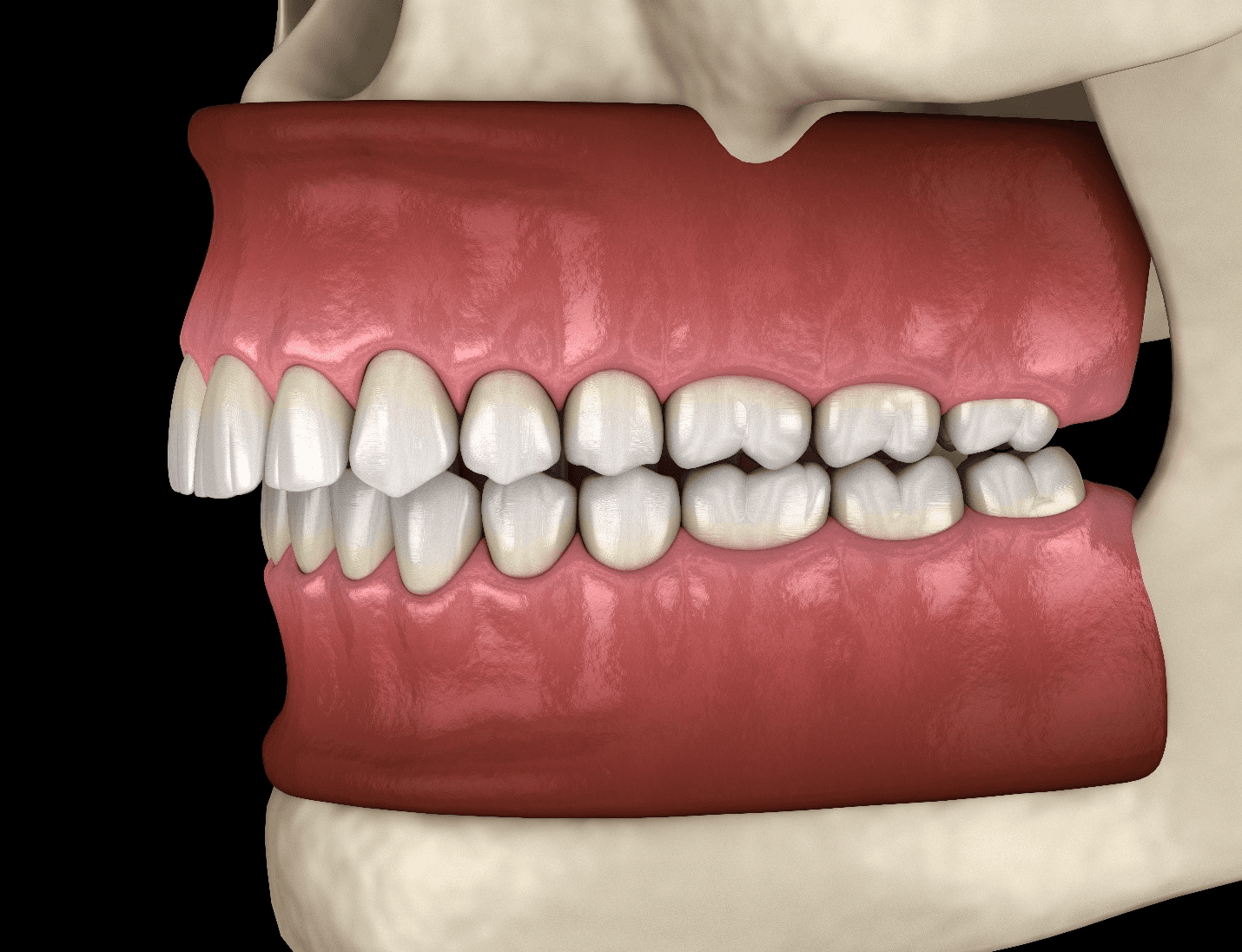 overbite issue