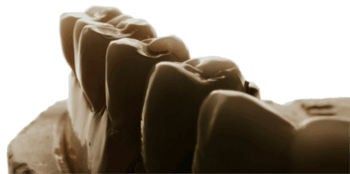 Sepia-toned close-up of a dental plaster cast showing molar crown preparations, on a transparent background