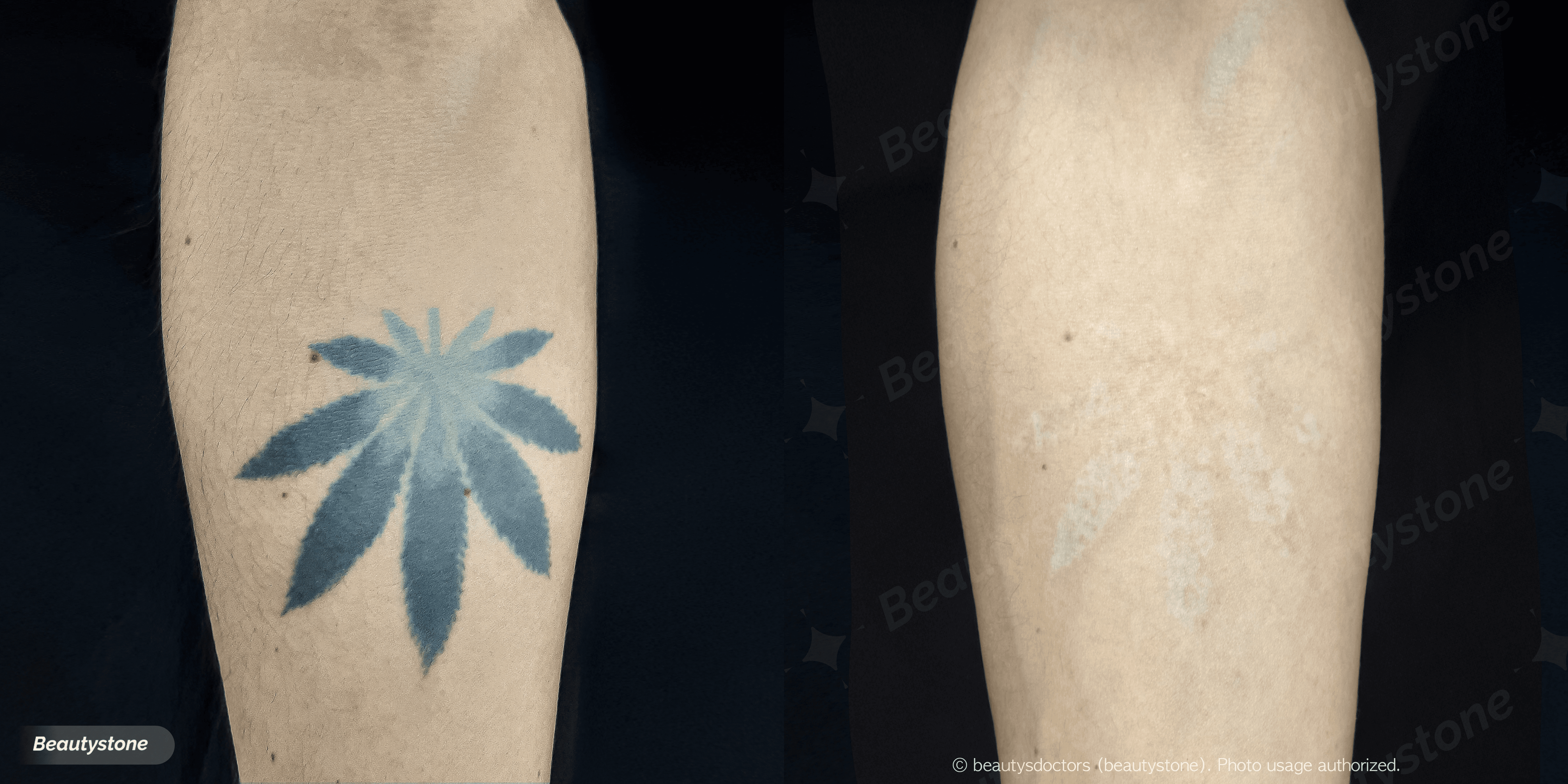  노란색 문신, 피코웨이로 지워질까요?