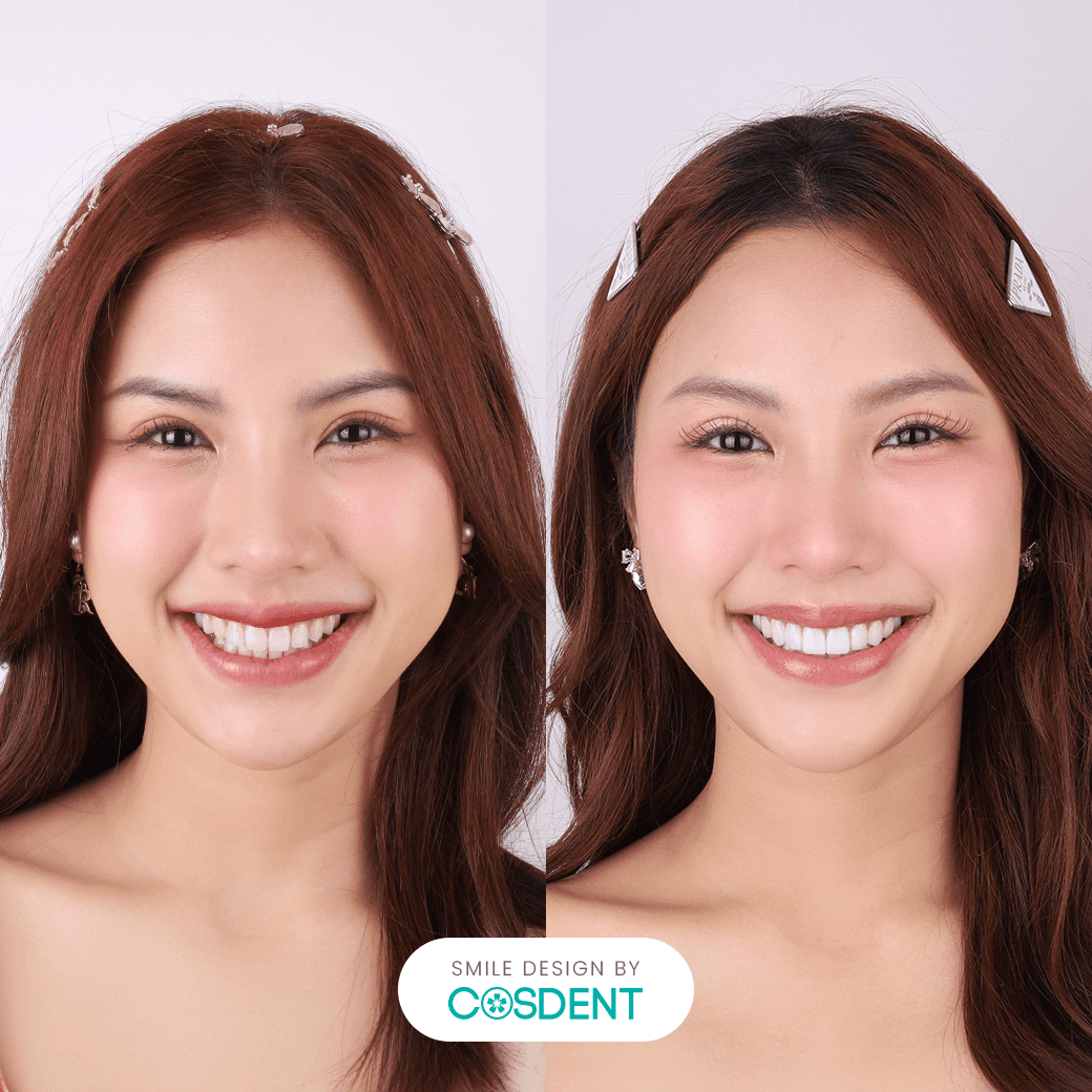 รูปไข่ 20 ซี่ เปรียบเทียบ