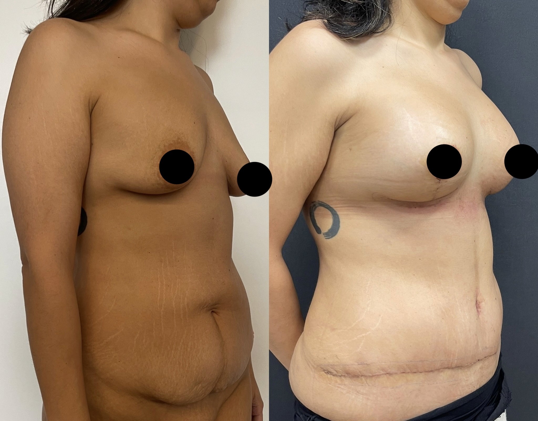 15 days post-op mommy makeover before after tuberous breast correction with breast lift implant and tummy tuck3