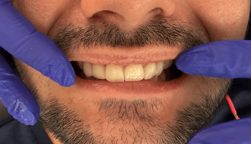 After treatment
