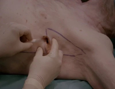 Chest tube