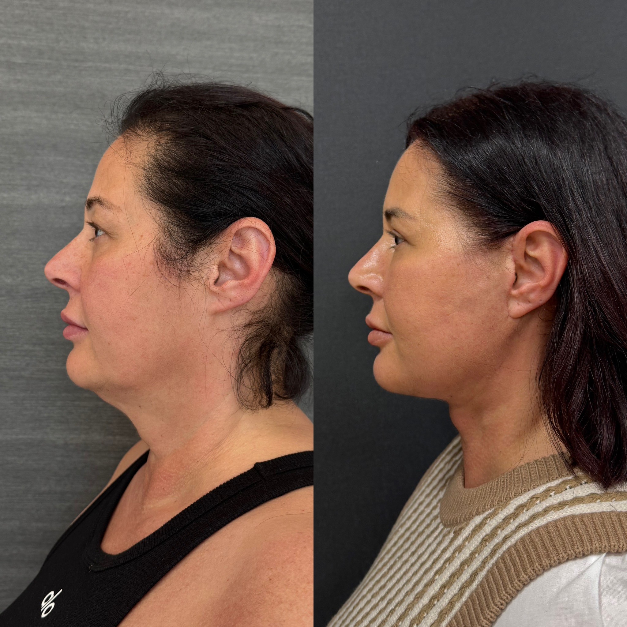 1 month before after result of deep plane face neck lift side view