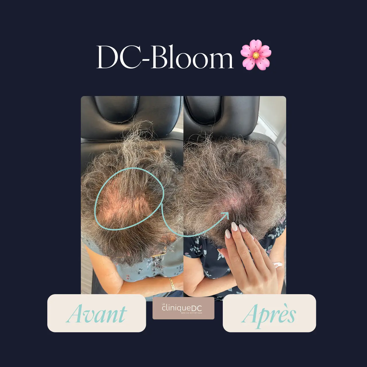 avant-après epilation laser visage