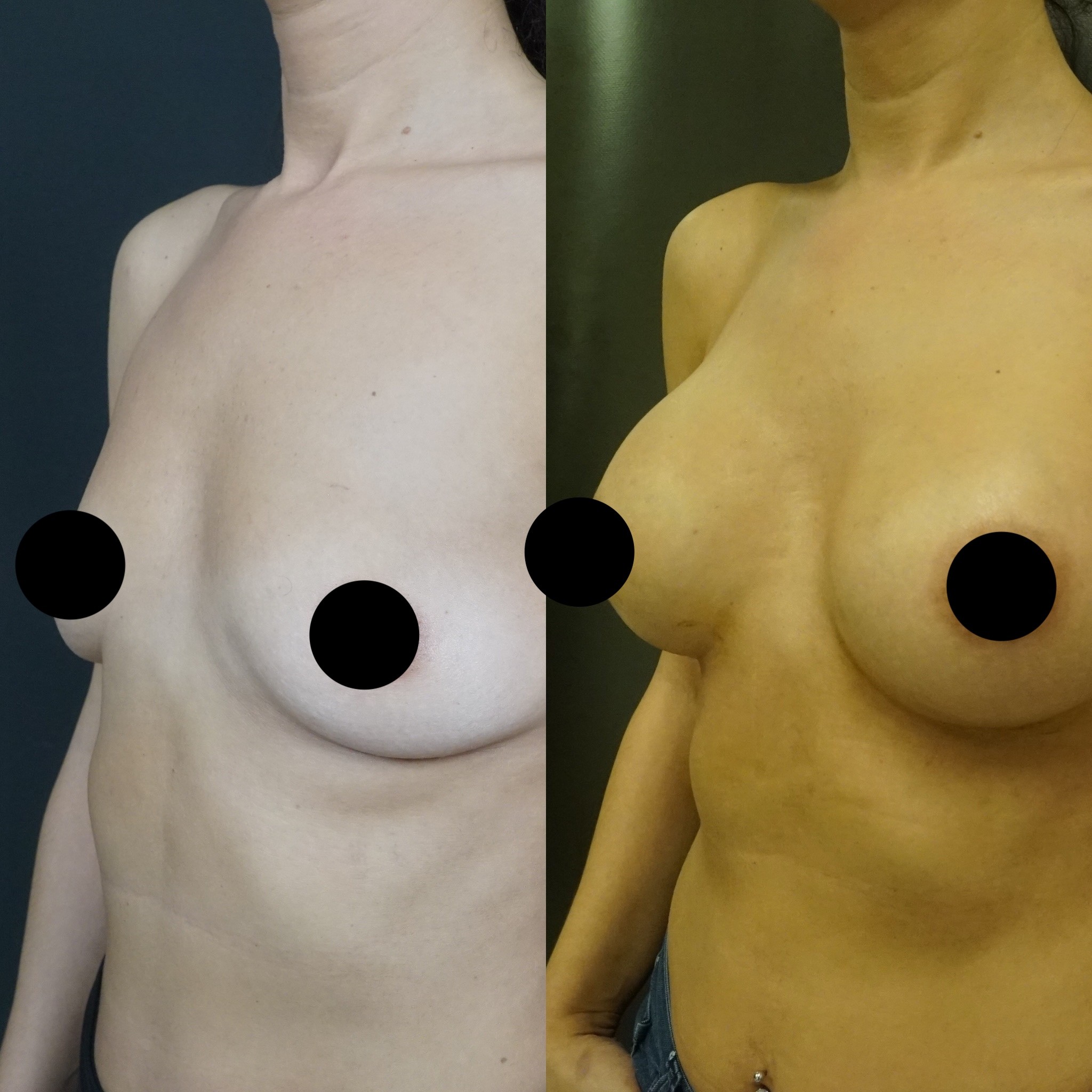 breast augmentation 4 months result left oblique view