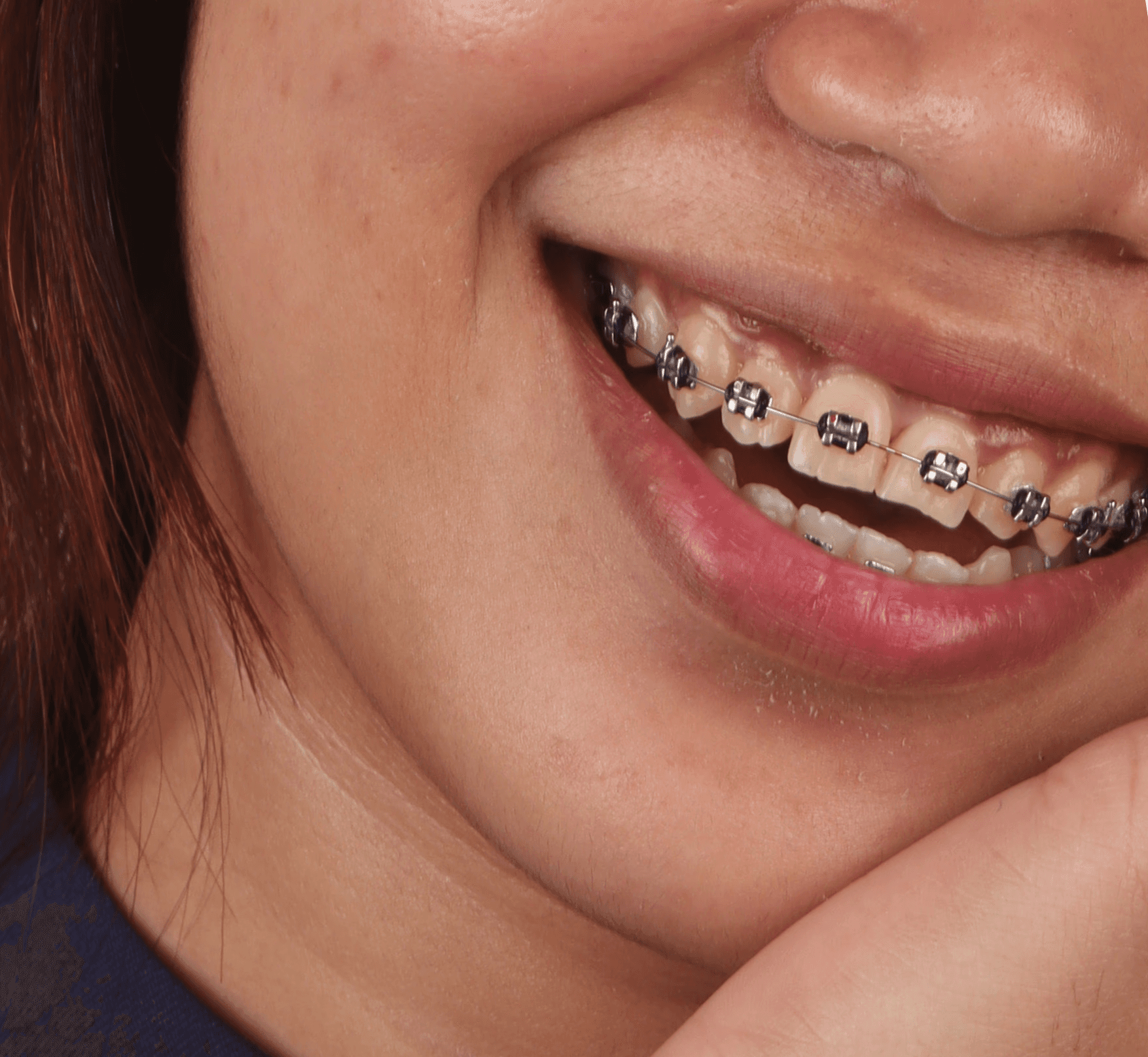 Woman smiling with straight wire braces, highlighting professional orthodontic treatments and teeth alignment at Ora Dental.