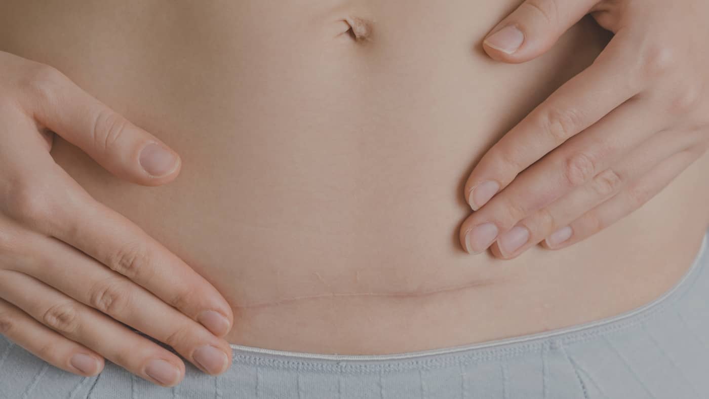 Ventre de maman avec une cicatrice de césarienne guérie, illustrant la reprise du sport en post-partum.
