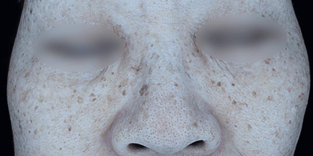 Pigmentation - Before