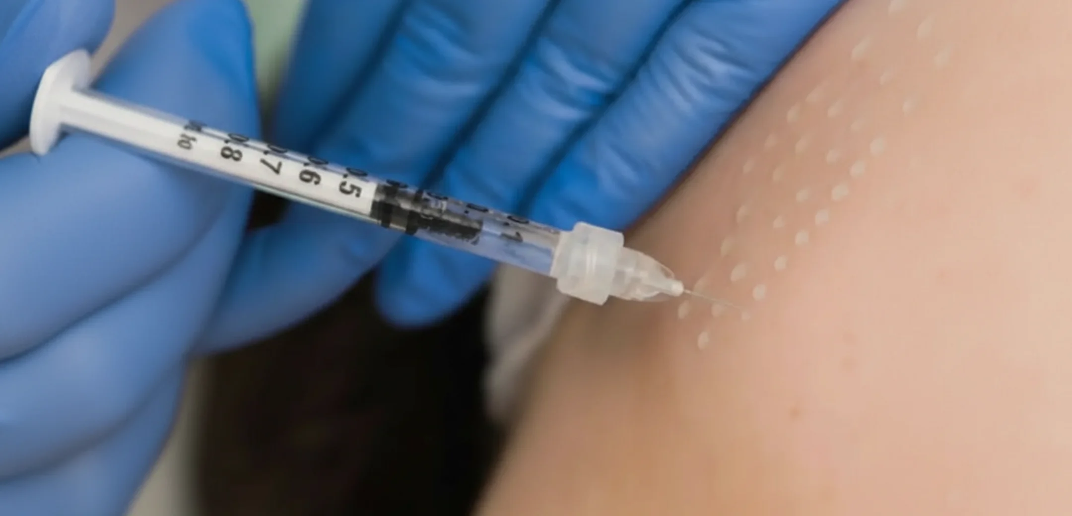 pokazany zabieg mezoterapi igłowej w gabinecie Belleza Rzeszów